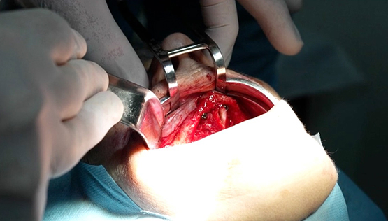 snapshot implant - 05