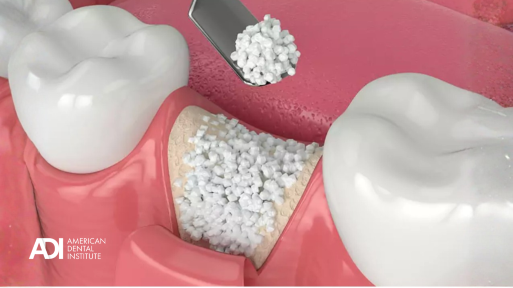 Bone grafting material placed in extraction site between adjacent teeth
