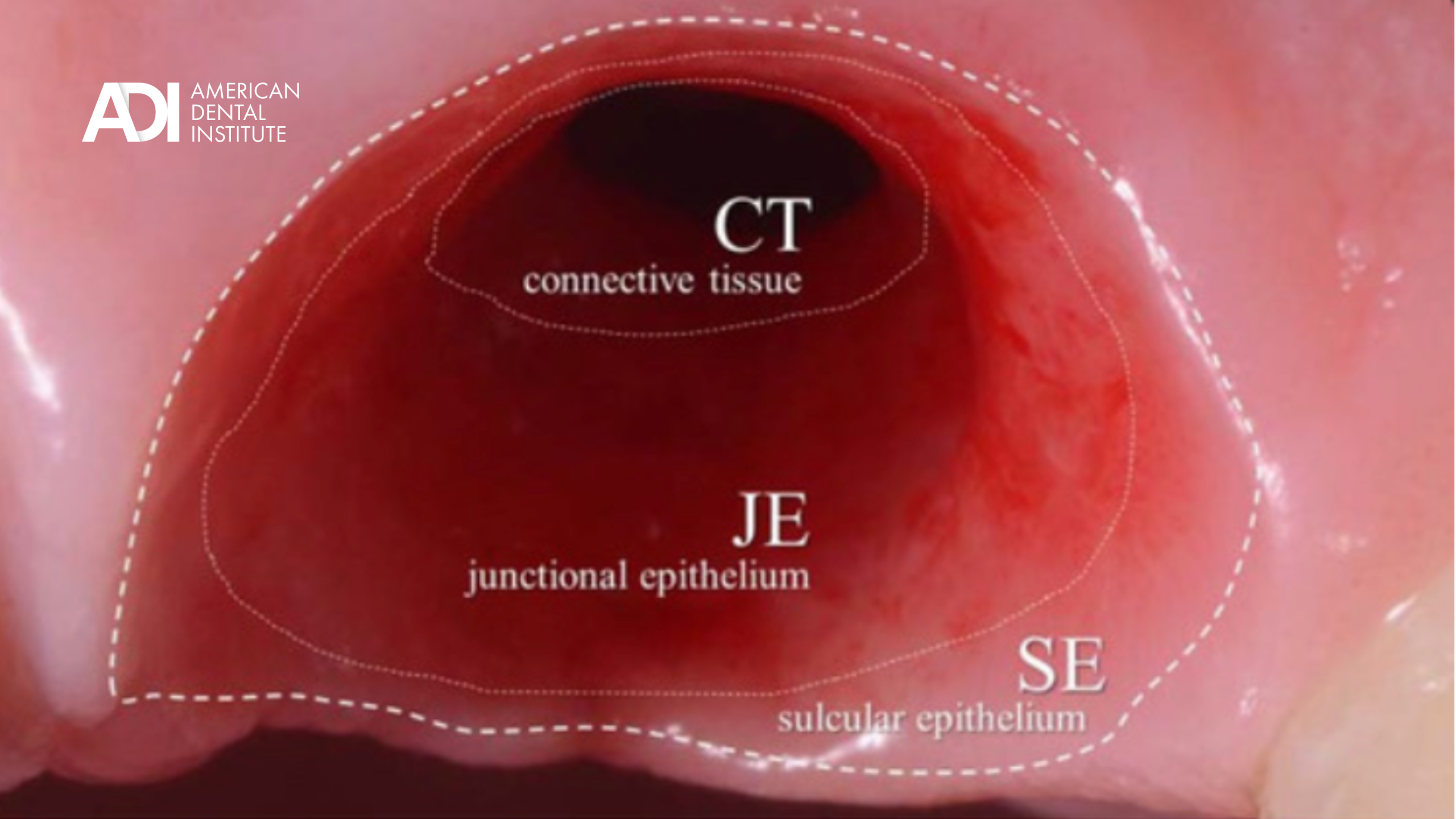 Close-up clinical view of keratinized tissue surrounding a dental implant