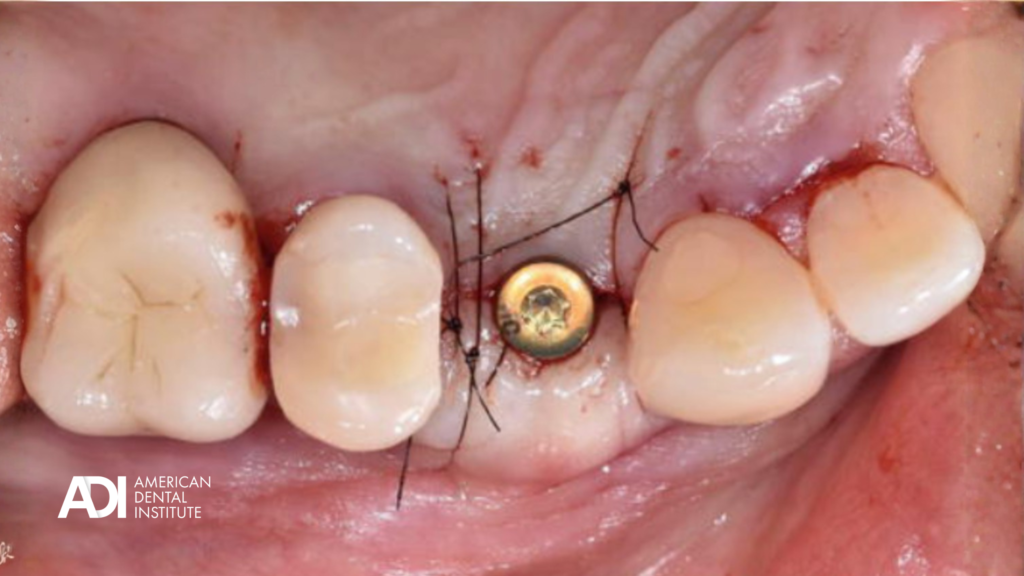 Healing abutment with sutures following connective tissue graft placement around a dental implant